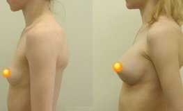 Фото до и после увеличения груди каплевидными имплантатами