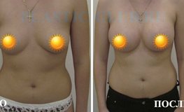 Фото до и после увеличения груди с использованием каплевидных имплантатов