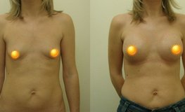 Фото до и после увеличения груди с использованием разреза по ареоле