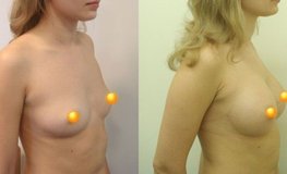 Фото до и после увеличивающей маммопластики через субмаммарную складку
