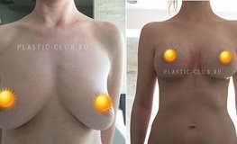 Фото до и после маммопластики с последующей коррекцией