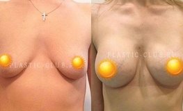 Фото до и после операции по увеличению груди имплантатами Natrelle 295 мл