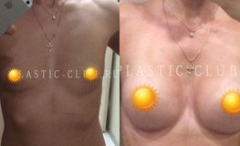 Фото до и после увеличения груди имплантатами объемом 295 мл