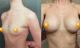 Фото до и после увеличивающей маммопластики имплантатами Natrelle 320 мл