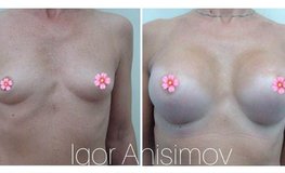 Фото до и после увеличения объема груди и коррекция ее формы