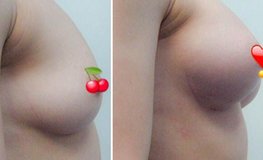 Фото до и после аугментационной маммопластики с помощью имплантатов