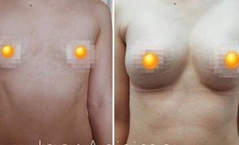 Фото до и после аугментационной пластики груди