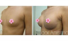 Фото до и после аугментационной маммопластики с применением имплантатов