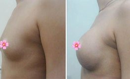 Фото до и после коррекции формы груди силиконовыми имплантатами