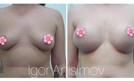 Фото до и после коррекции груди с применением имплантатов