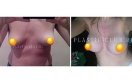 Фото до и после маммопластики грудными имплантатами объема 450 мл