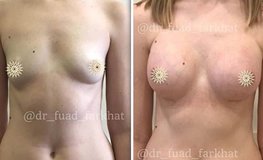 Фото до и после увеличения груди по авторской методике 