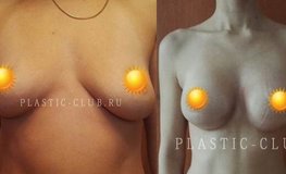 Фото до и после увеличивающей маммопластики имплантатами круглой формы