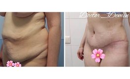 Фото до и после блока операций по коррекции фигуры после сильного похудения