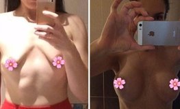 Фото до и после установки имплантатов на тубулярную грудь
