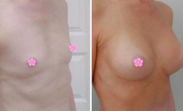 Фото до и после маммопластики с установкой имплантатов после диагноза амастия