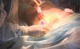 Фото процесса липофилинга груди
