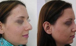 Фото до и после риносептопластики из-за недовольства формы носа