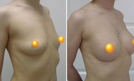 Фото до и после операции по установке имплантатов и устранению гипомастии