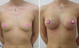 Фото до и после увеличивающей маммопластики и коррекции формы груди