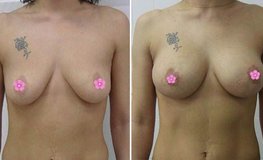 Фото до и после операции по увеличению груди имплантатами с объемом 310 мл