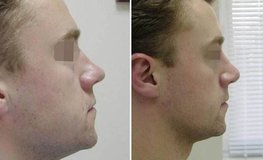 Фото до и после ринопластики, устранение искривления формы носа