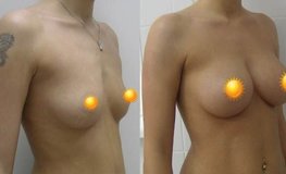 Фото до и после увеличивающей маммопластики имплантатами объемом 300 мл