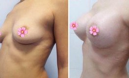 Фото до и после мастопексии и установки имплантов