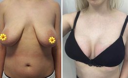 Фото до и после якорной подтяжки груди с использованием имплантов Arion