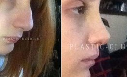 Фото до и после ринопластики