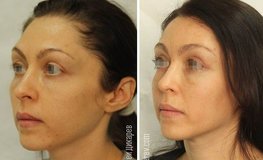 Фото до и после омолаживающей хирургии лица
