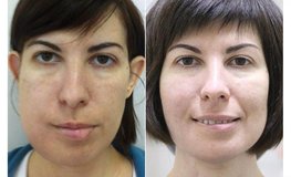 Фото до и после устранения опухоли нижней челюсти