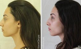 Фото до и после риносептопластики, редукции спинки носа с устранением горба