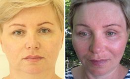 Фото до и после периорбитального омоложения лица и шеи