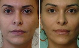 Фото до и после подтяжки лица с эффектом омоложения