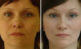 Фото до и после пластики лица и подбородка