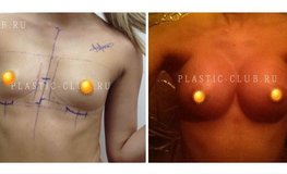 Фото до и после маммопластики с установкой имплантатов разрезом под грудью