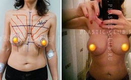 Фото до и после операции маммопластика на асимметричной груди