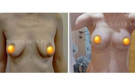 Фото до и после подтяжки и увеличения груди по новой методике