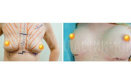Фото до и после проведения увеличения груди с асимметрией