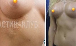Фото до и после увеличивающей маммопластики с ожогом под грудью