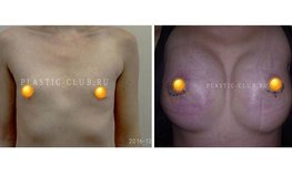 Фото до и после увеличения груди анатомическими имплантатами 410 мл