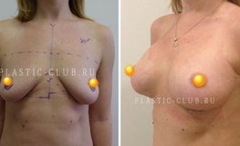 Фото до и после эндопротезирования груди на килевидной грудной клетке