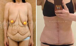 Фото до и после абдоминопластики с подтяжкой груди