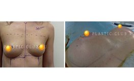 Фото до и после пластики груди с асимметрией