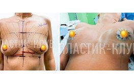 Фото до и после коррекции груди разной по форме