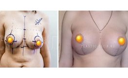 Фото до и после увеличения груди имплантатами Ментор 400 мл
