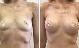 Фото до и после увеличения груди круглыми имплантатами под мышцу