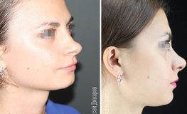 Фото до и после коррекции бульбообразной деформации кончика носа