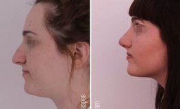 Фото до и после имиджевой риносептопластики, понижение спинки носа